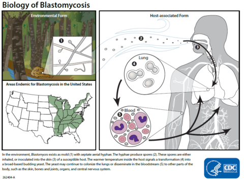 Blastomycosis- Increasing cases reported in Upstate NY